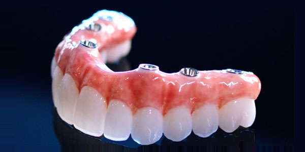 hybrid bridge implant teeth