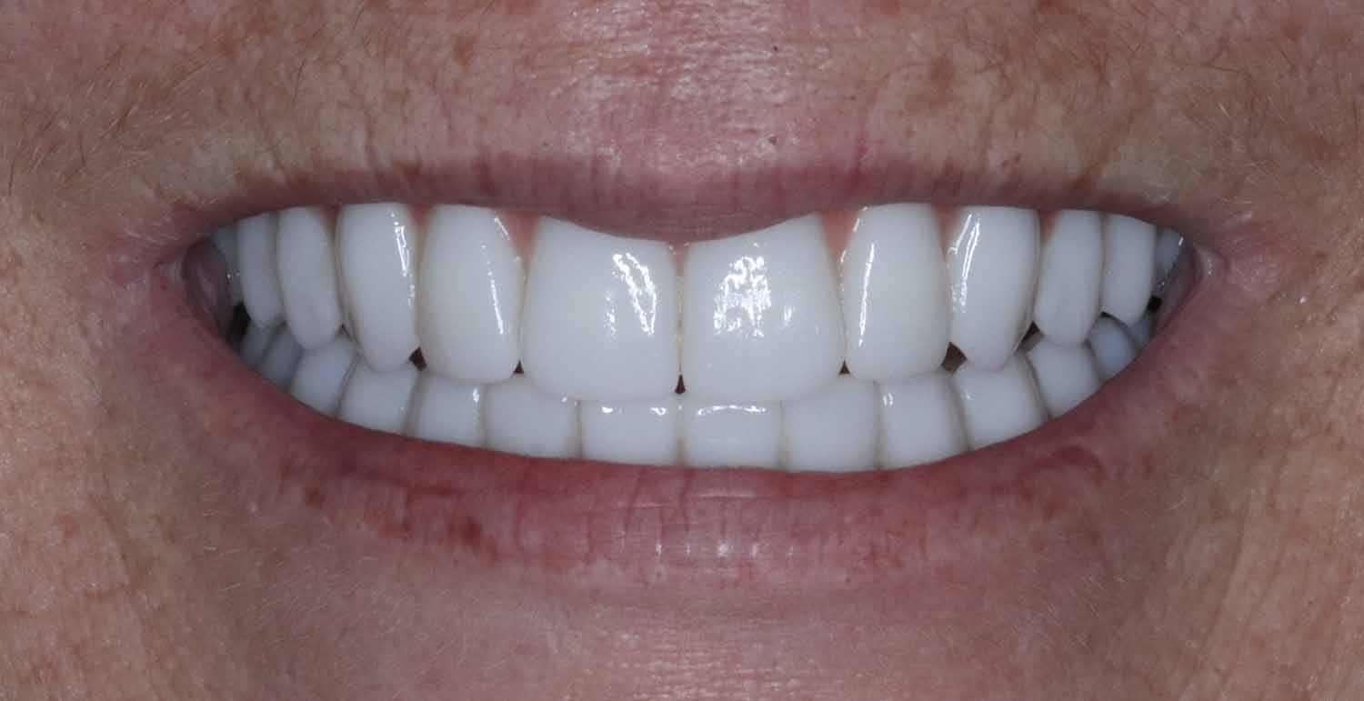 D5 Teeth - 7 Day Transformation