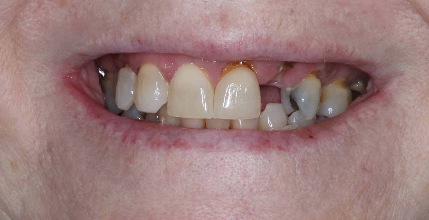 Before Dental Procedure