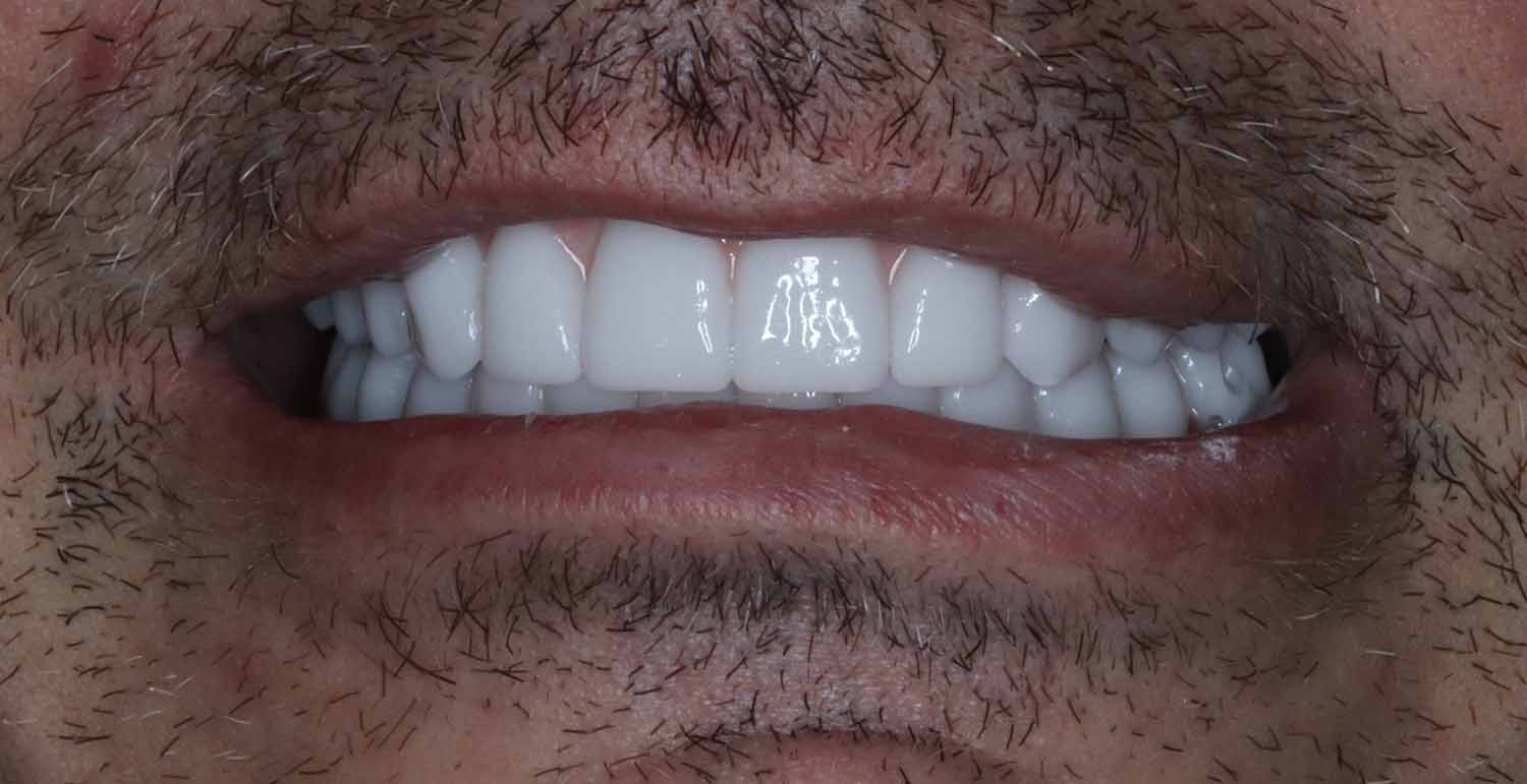 Post Dental Procedure