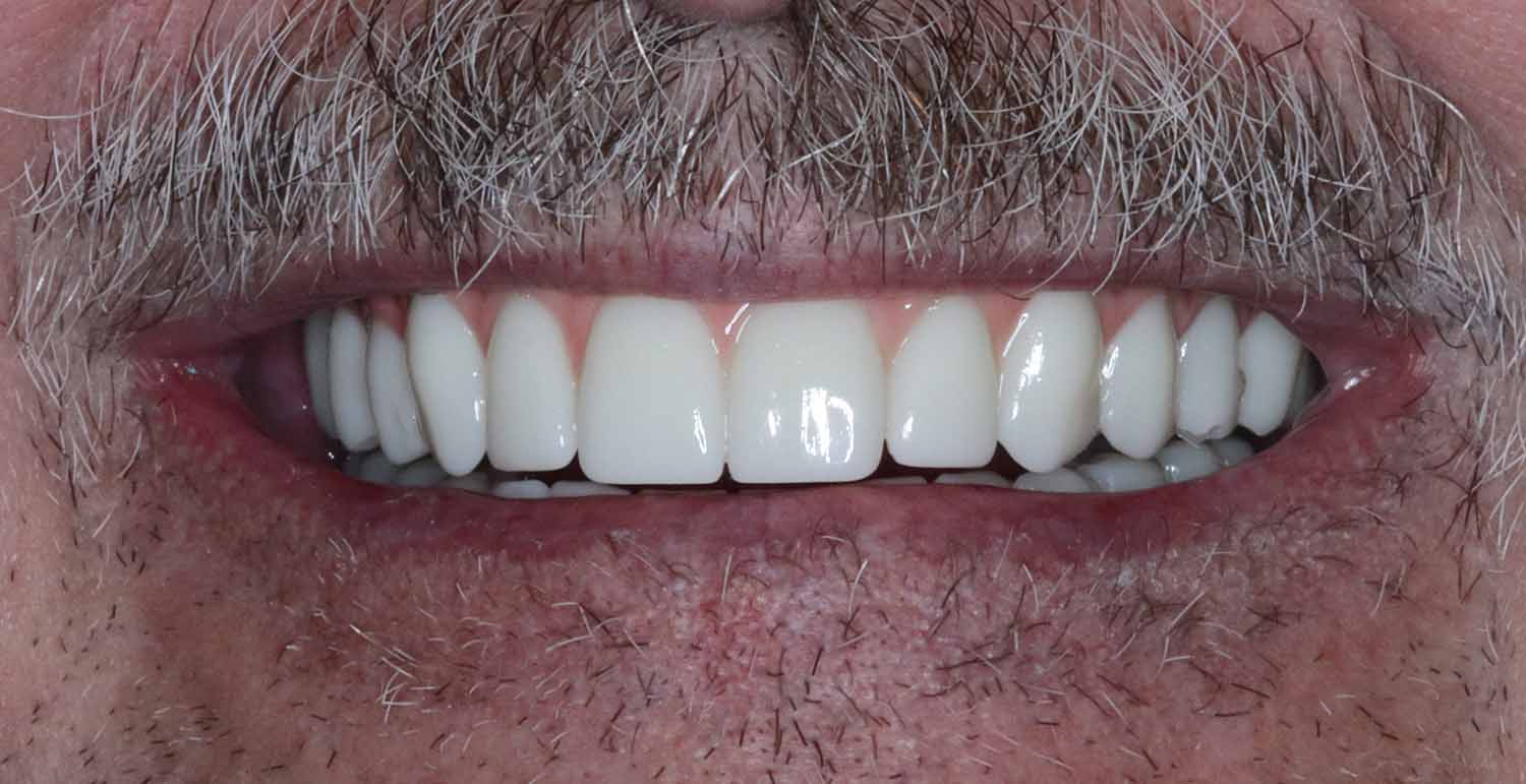Post Dental Procedure