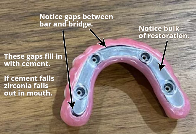 Nuvia - titanium bar restoration